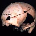 Coldrum, unhealed cranial trauma (Duckworth Laboratory, Cambridge, Eu.1.5.120)